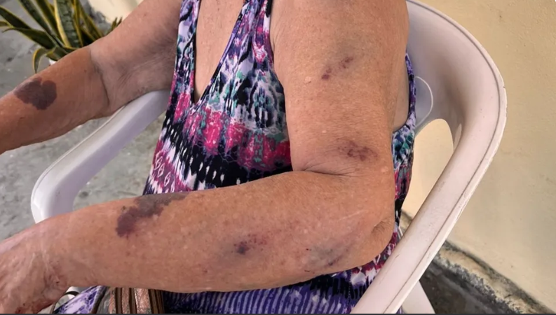 Idosa de 87 anos é agredida pela neta com cabo de vassoura